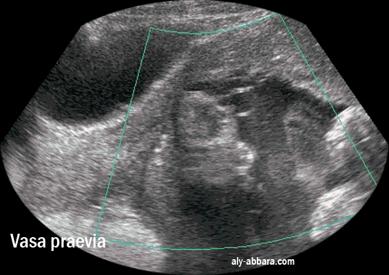 Vasa praevia et placenta praevia