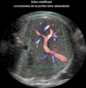 Image montrant le trajet parcouru par la veine ombilicale à l'intérieur de la cavité abdominale du foetus