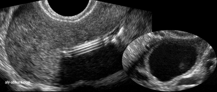 Image échographique montrant l'aspect l'apparition d'un kyste fonctionnel à l'ovaire gauche, deux mois après la pose de dispositif intra-utérin hormonal