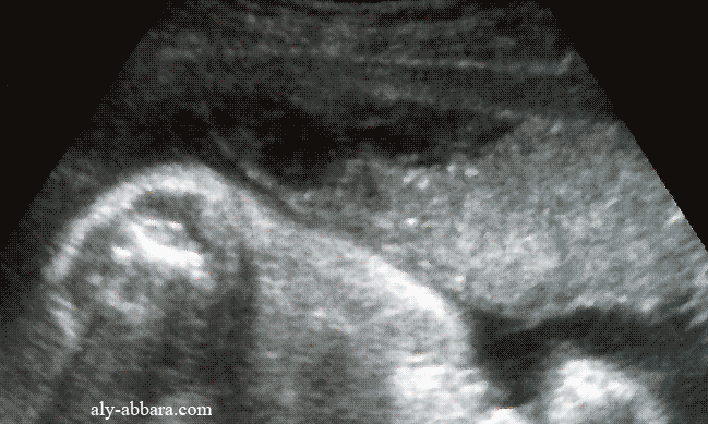 Hématome rétroplacentaire marginal à 29 semaines d'aménorrhée