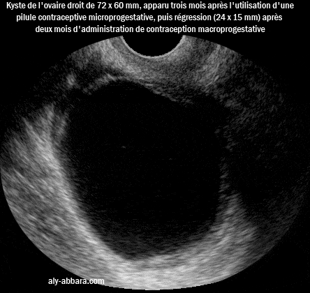 Kyste ovarien droit fonctionnel, apparut après 3 mois d'utilisation de contraception microprogretatif
