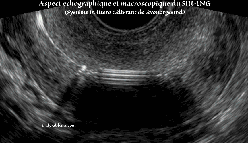 Image échographique montrant l'aspect l'apparition d'un kyste fonctionnel à l'ovaire gauche, deux mois après la pose de dispositif intra-utérin hormonal