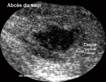 Abcès du sein avec sa coque épaisse et son contenu du pus