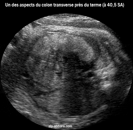 Un des aspects physiologique du côlon transverse au cours des dernières semaines de la grossesse