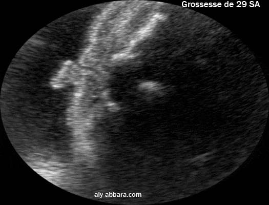Une coupe échographique coronale montrant une partie de du pavillon de l'oreille externe et le conduit auditif externe