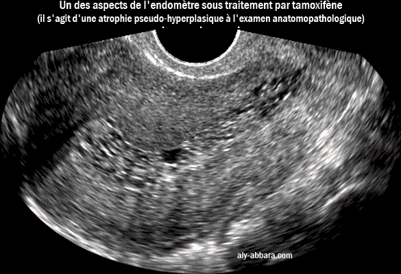 Un des aspects de l'endomètre sous traitement par tamoxifène, il s'agit d'une atrophie endométriale pseudo-hypertrophique