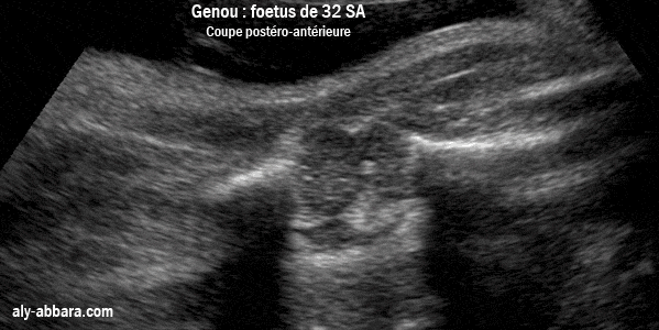 Genou d'un foetus de 32 semaines d'aménorrhée