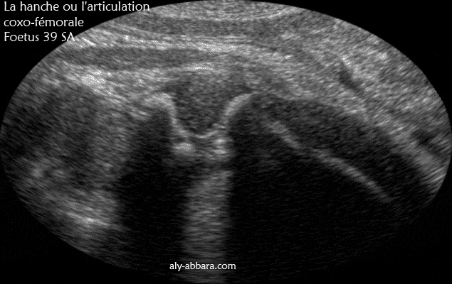 Image échographique montrant les éléments anatomiques composant la hanche ou l'articulation coxo-fémurale