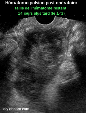 Image échographique montrant la vitesse de la résorption d'un hématome pelvien