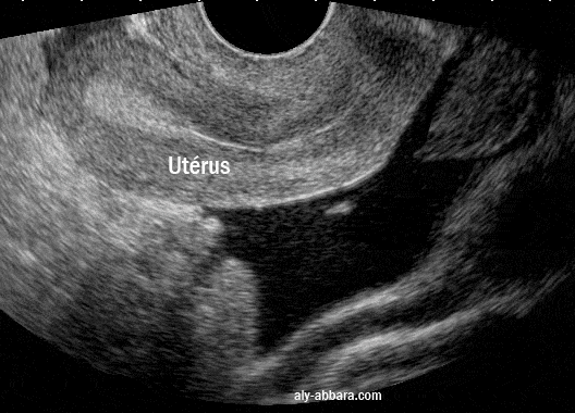Image montrant l'aspect échographique d'un hémopéritoine suite à une rupture d'un kyste fonctionnel ovarien