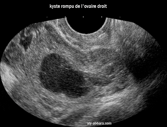 Kyste rompu de l'ovaire droit