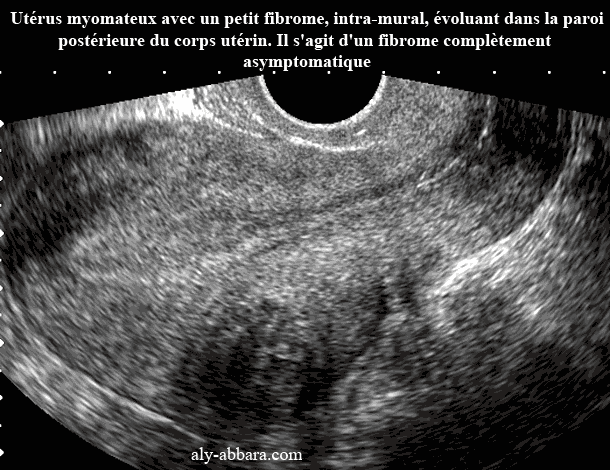 Myome intra-mural asymptomatique