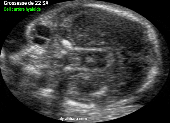 Image échographique prise à 22 SA de grossesse et mettant en évidence, sur une coupe transversale du l'oeil, le reliquat de l'artère hyaloïde