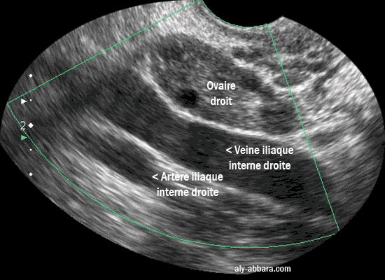 L'ovaire droit dans sa fosse ovarique, on remarque la présence de la veine et l'artère iliaque internes droites