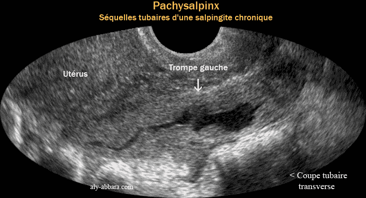 Trompe atteinte d'une pachsalpingite