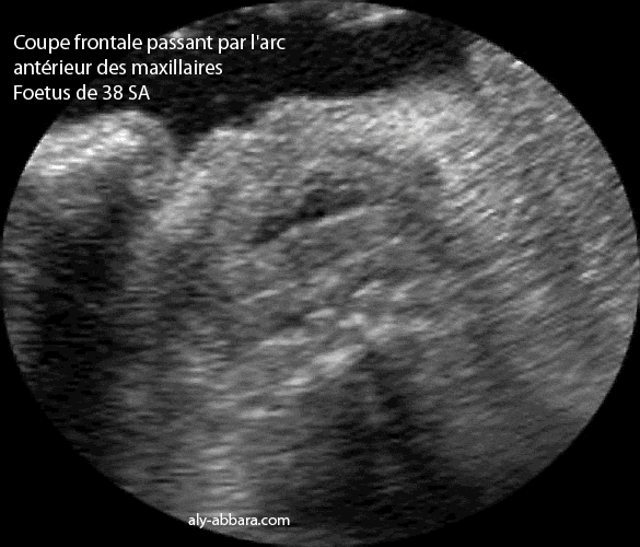 Coupe échographique frontale passant par l'arc antérieur du maxillaire inférieur et mettant en évidence les incisives inférieures encore enfuites dans la mandibule