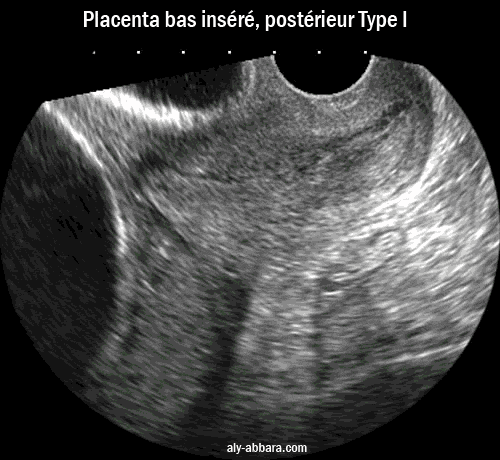 Placenta praevia postérieur, type III - IV