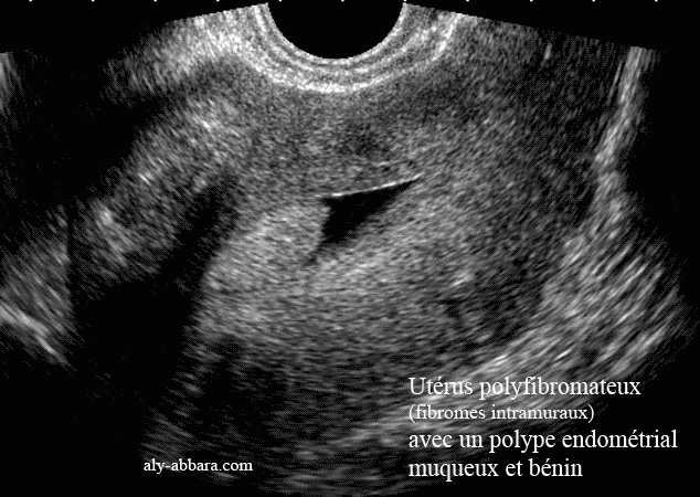 Polype endométrial bénin, muqueux et pédiculé