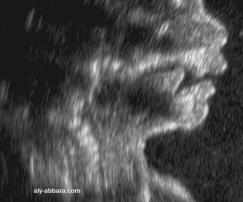 Coupe échographique sagittale médiane de la partie basse de la face foetale à 22 SA ; l'image montre les éléments formant la bouche et la cavité buccale : lèvre supérieure et inférieure, les maxilaires supérieur et inférieur et la langue