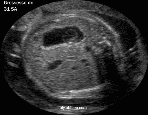 Image échographique montrant l'estomac foetal avec son contenu prenant la forme d'un pseudokyste et disparaissant 10 minutes plus tard