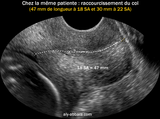 Image échographique montrant l'utilité de l'échographie dans la surveillance du col utérin, car le col passe de 47 mm de longueur à 18 SA, à 30 mm à 22 SA en restant cliniquement toujours fermé