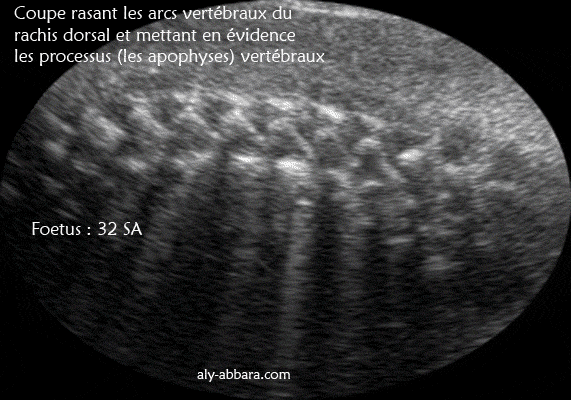 Rachis dorsal : coupe rasant les arcs vertébraux et montrant les processus (ou les apophyses épineux et les processus transverses