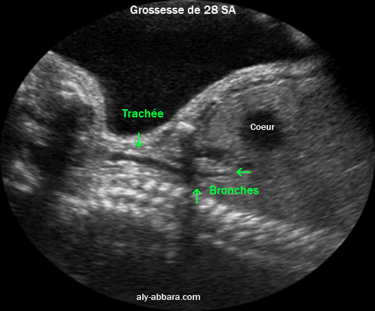 Coupe échographique sagittale médiane du cou et du thorax mettant en évidence la trachée et les deux bronches principales