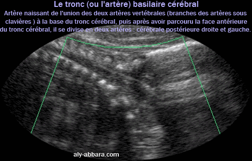 Image échographique montrant sur une coupe sagittale médiane le tronc (ou l'artère) basilaire parcourant la face antérieure du tronc cérébral. Il s'agit d'une artère naissant par l'union des deux artères vertébrales à la base du cerveau ; elle se divise à la fin de son parcours sur la face antérieure du tronc cérébral pour donner les deux artères cérébrales postérieures