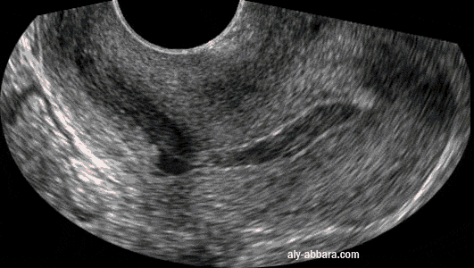 Utérus à diverticule pariétal postérieur