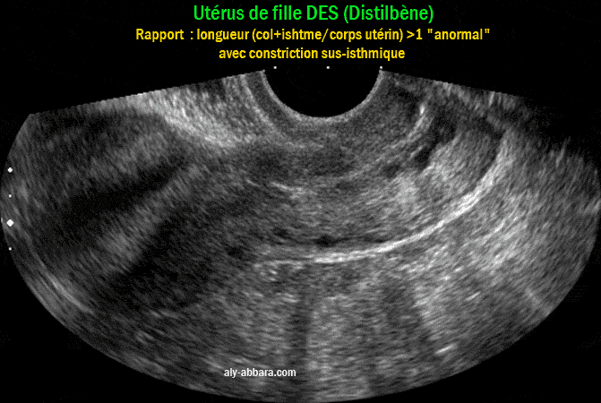 Utérus d'une fille DES présentant un prolongement inhabituel de la portion supra-vaginale du col utérin avec un rapport de la longueur du col et l'isthme utérin (45mm) par rapport à la longueur du corps utérin (40mm), c'est-à-dire un coprs utérin proportionnellement court