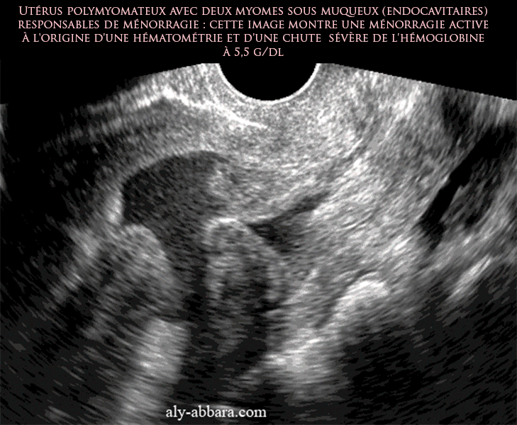 Utérus polymyomateux avec deux myomes endocavitaires à l'origine d'une hématométrie et ménorragie sévère