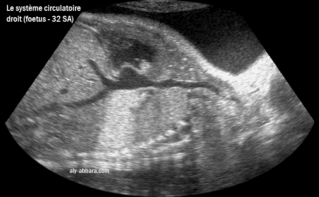Le coeur droit et le retour veineux par la veine cave supérieure et inférieure