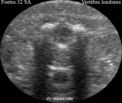 Anatomie d'une vertèbre lombaire chez un foetus de 32 SA