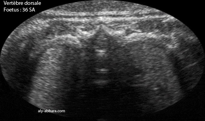 Vertèbre thoracique - grossesse de 36 semaines d'aménorrhée