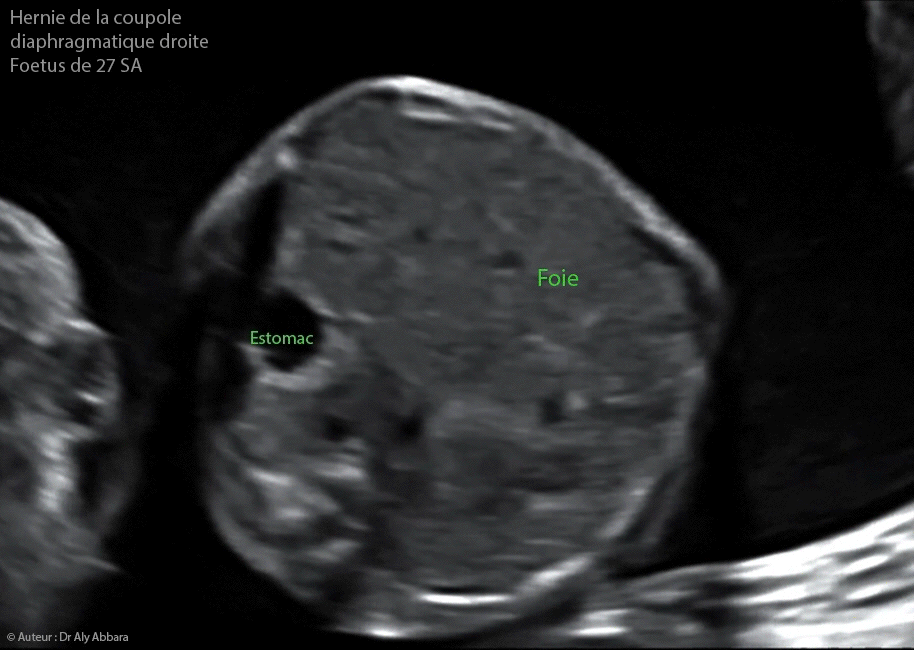 Hernie-diaphragmatique mise en évidence à 13 SA et 14 jours dans un contexe polymalformatif