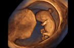 Hernie ombilicale physiologique du premier trimestre de la grossesse - deux cas à 10 SA et 2 jours