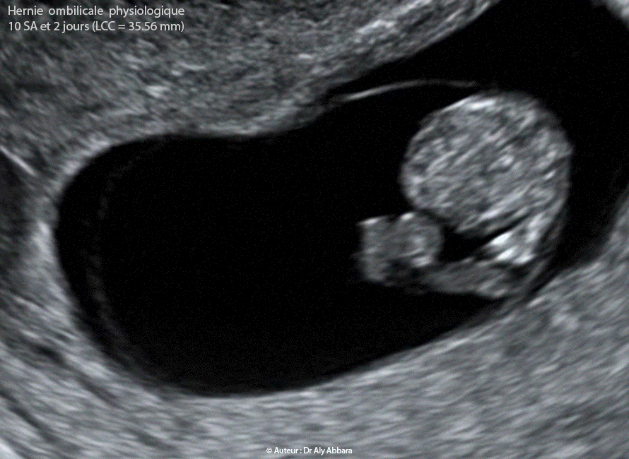 Hernie ombilicale physiologique du premier trimestre de la grossesse - Physiologic umbilical hernia - Physiologic Gut Heriation