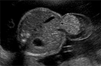 Omphalocèle (exomphalos - Foetus de 23 SA - Cas clinique et description de la pathologie