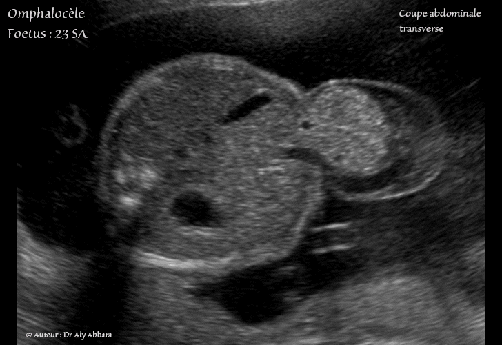 Omphalocèle isolée chez un foetus de 23 SA - Contenu composé des intestins exclusivement