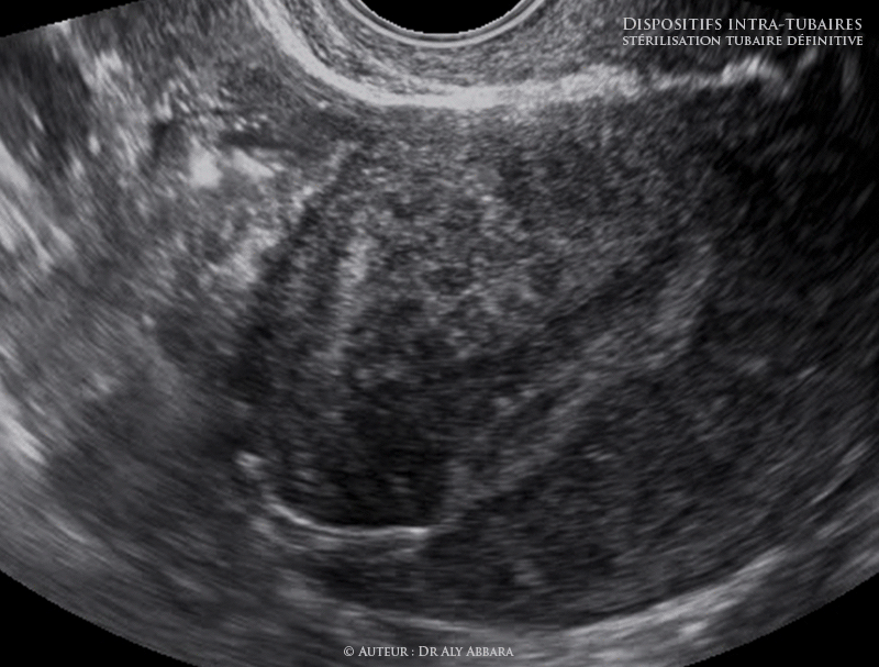 Utérus - Dispositif contraceptif définitif intra-tubaire - Aspects échographiques