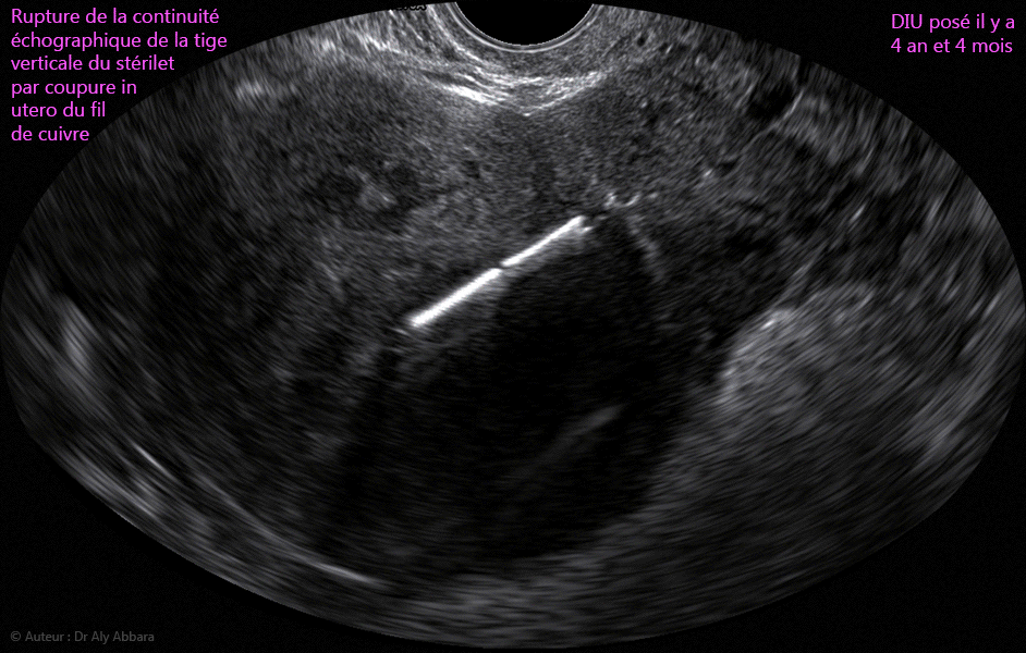 Images échographiques et séquence vidéo montrant, sur des coupes sagittales de l'utérus, la rupture de la continuité échographique de la tige verticale d’un DIU par coupure, in utero, de son fil de cuivre