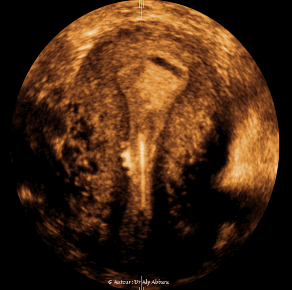 DIU au cuivre : déplacemet vers le canal endocervical sous l'effect des contractions utérines