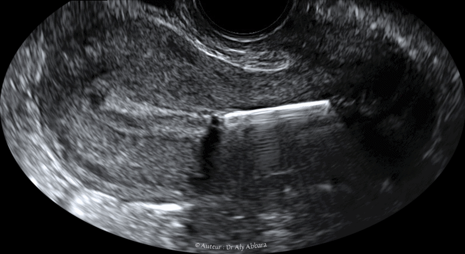 DIU au cuivre : déplacemet vers le canal endocervical sous l'effect des contractions utérines