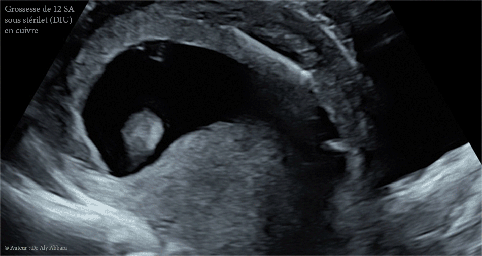 Grossesse intra-utérine évolutive de 12 SA sous DIU (stérilet) au cuivre - Échec de l'effet contraceptif