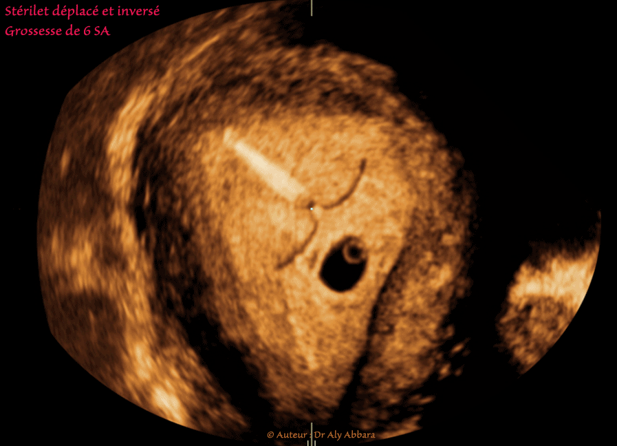 DIU au cuivre : déplacemet vers le canal endocervical sous l'effect des contractions utérines