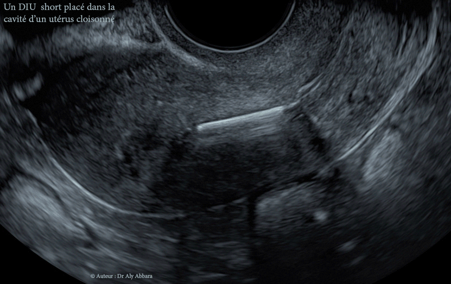 Positionnement d'un DIU au cuivre dans la cavité d'un utérus malformé, cloisonné
