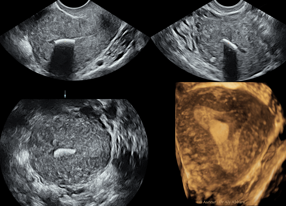 DIU au cuivre : déplacemet vers le canal endocervical sous l'effect des contractions utérines