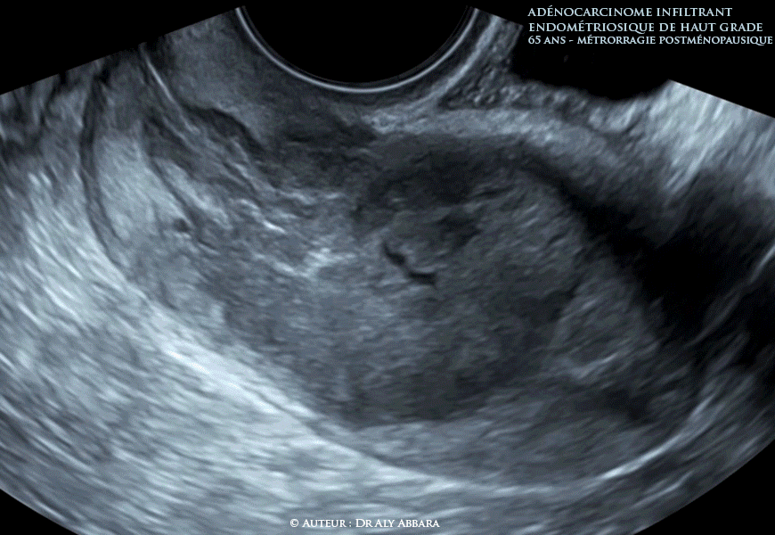 Utérus - Adénocarcinome endométroïde infiltrant de haut grade - Échographie