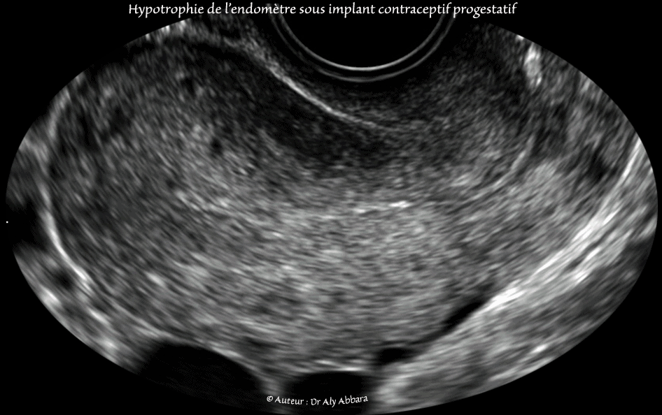 DIU au cuivre : déplacemet vers le canal endocervical sous l'effect des contractions utérines