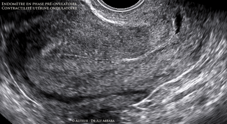 Utérus - la contractilité utérine ondulatoire etendomètre en fin de la phase proliférative - glaire cervicale préovulatoire - Follicule pré-ovulatoire